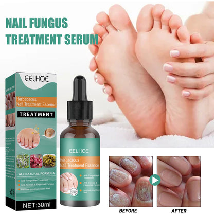 EELHOE Herbaceous Nail Relief Essence, Hand And Foot Nail Soft Thickening Brightening Nail And Bump Nail Care Solution