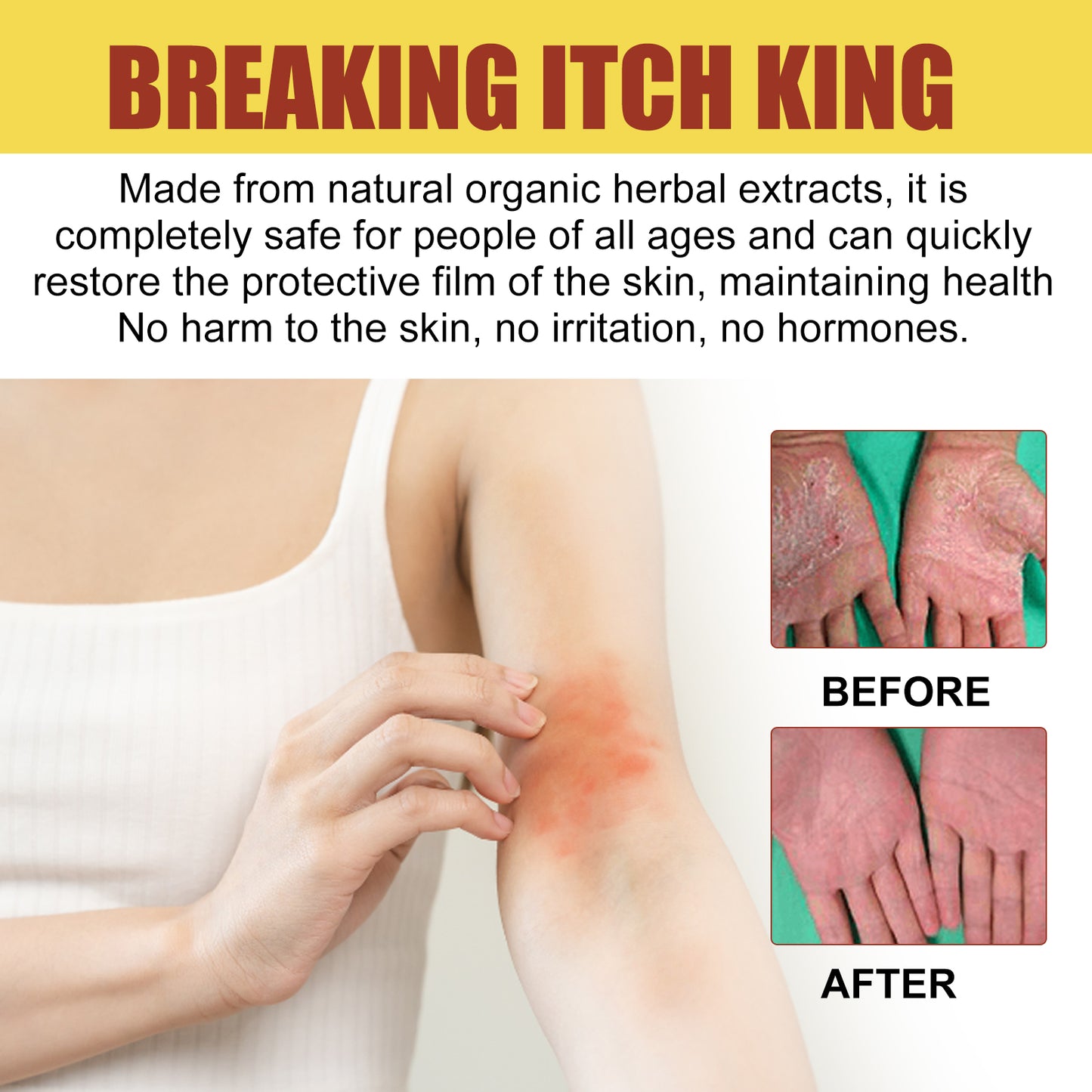 Breaking Itch King, Relieve Hand And Foot Moss Skin Moss Redness Repair Skin Itching Skin Care Cream