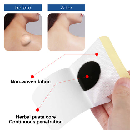 Lipoma Removal Patch, Soothing Various Body Fat Knots To Remove Subcutaneous Lumps Care Patch