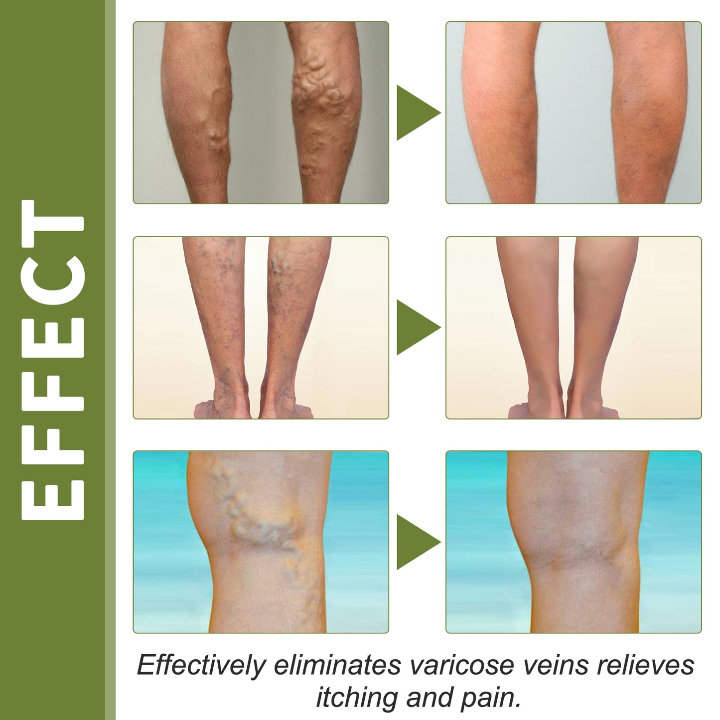 Vein Therapy Cream, Soothe Sore Swollen Leg Blood Vessels Repair Veins Body Care Cream